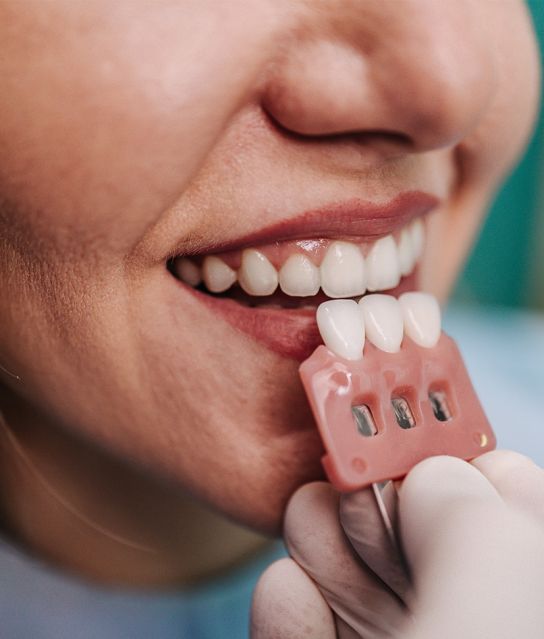 Veneers - Image